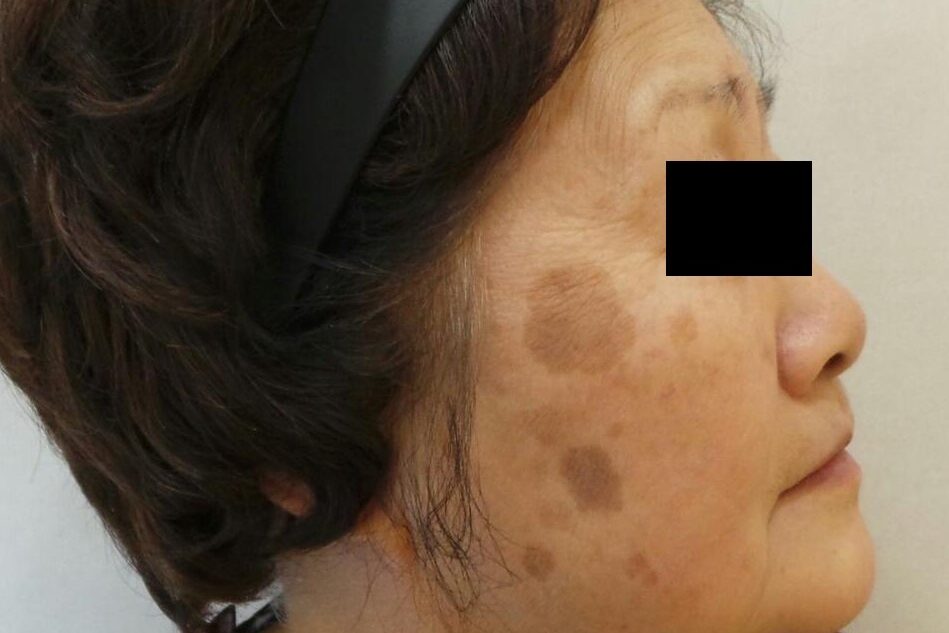 레이저 시행 전 흑자 검버섯 병변의 모습