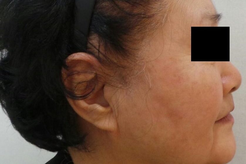 피코슈어 줌패스 추가 시행 후 개선된 흑자 검버섯 병변