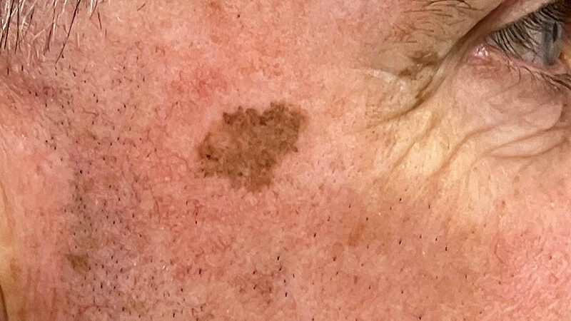 편평한 흑자 병변의 모습