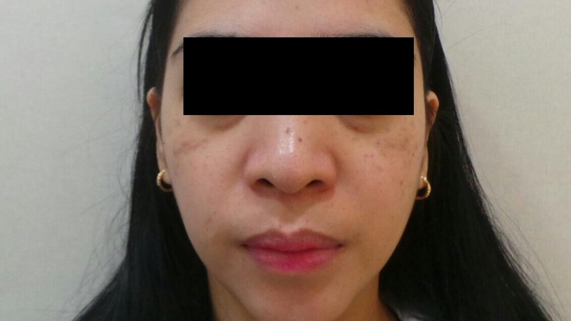 고양시 일산 리뉴앤영에서 피코슈어 치료 회차를 거듭할수록 밝아지는 후천성오타모반 병변의 모습을 관찰할 수 있다.