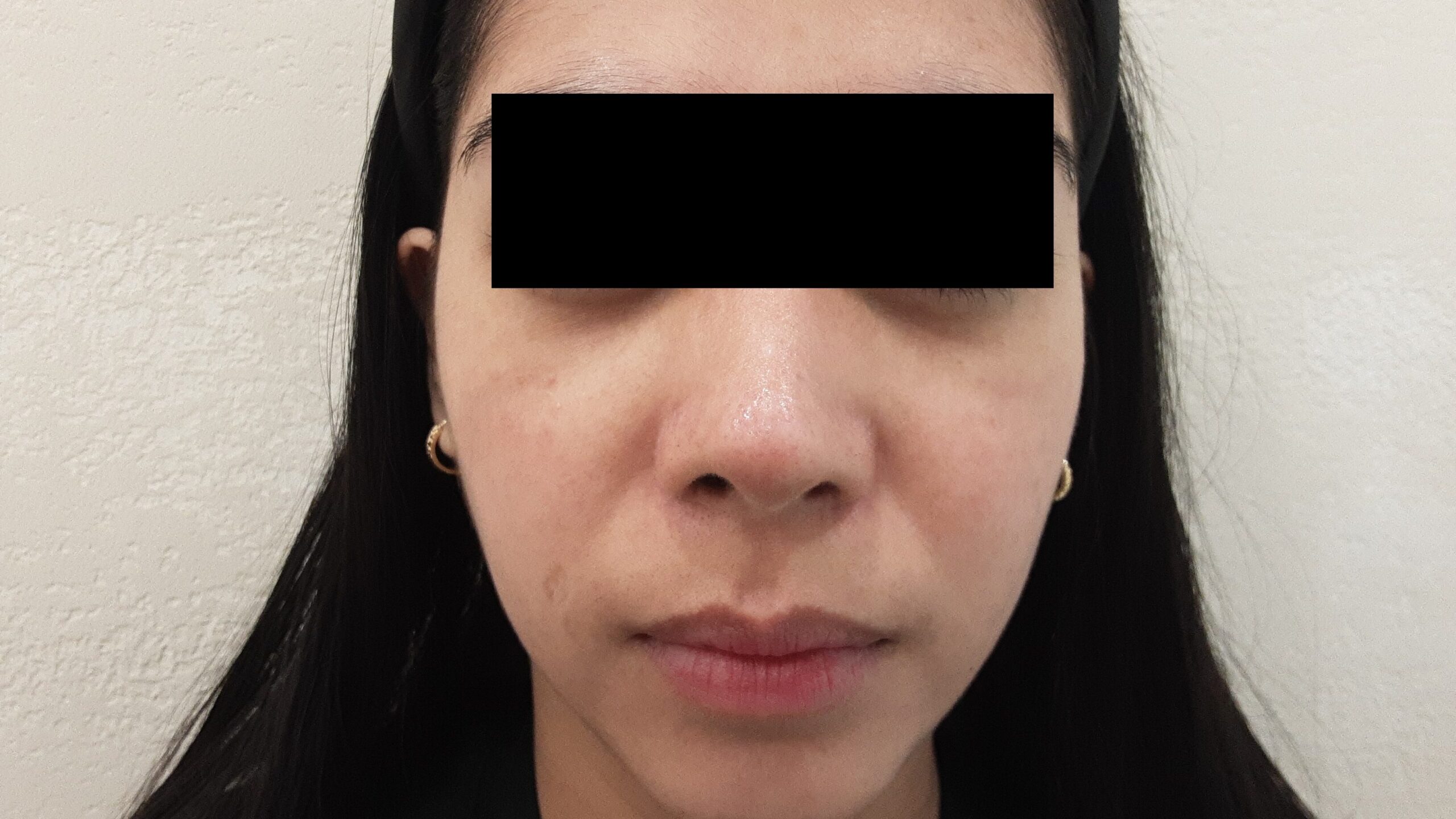 일산 리뉴앤영에서 피코슈어 755nm 레이저 치료 후 소실된 후천성오타모반(ABNOM) 실제 사례 전후사진