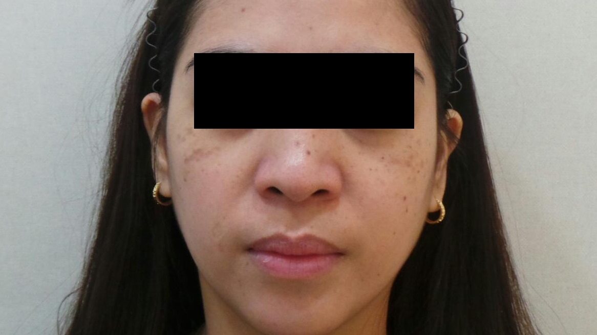 후천성오타모반, 후천성양측성오타양모반의 치료 전 사진. 양 쪽 광대에서 동글동글한 병변의 모습이 관찰됨.