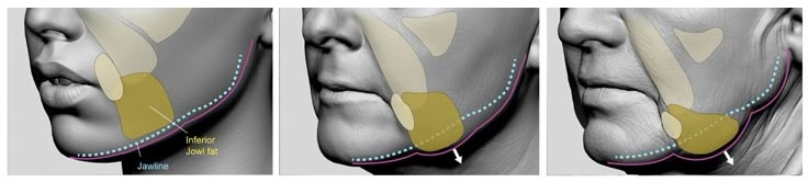 노화로 인해 볼 지방이 아래로 처진 얼굴 모습