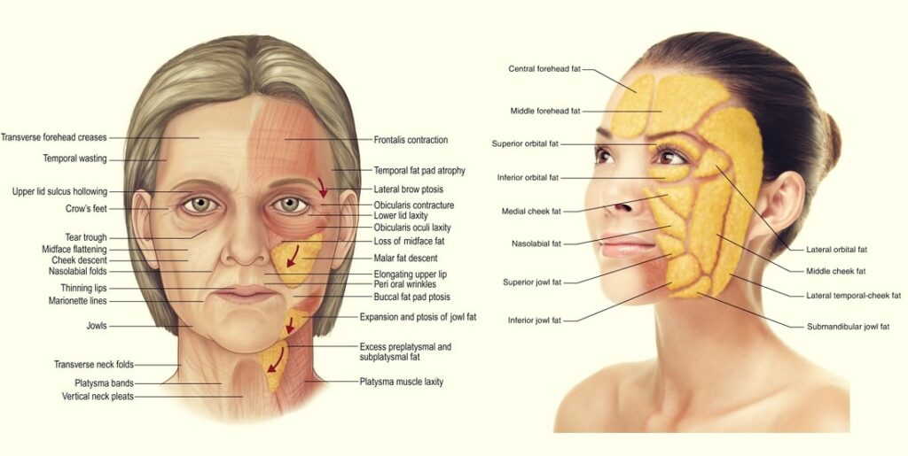중안면과 하안면에서 지방 패드가 아래로 이동한 위치를 표시한 해부학적 그림, 실리프팅이 필요한 경우