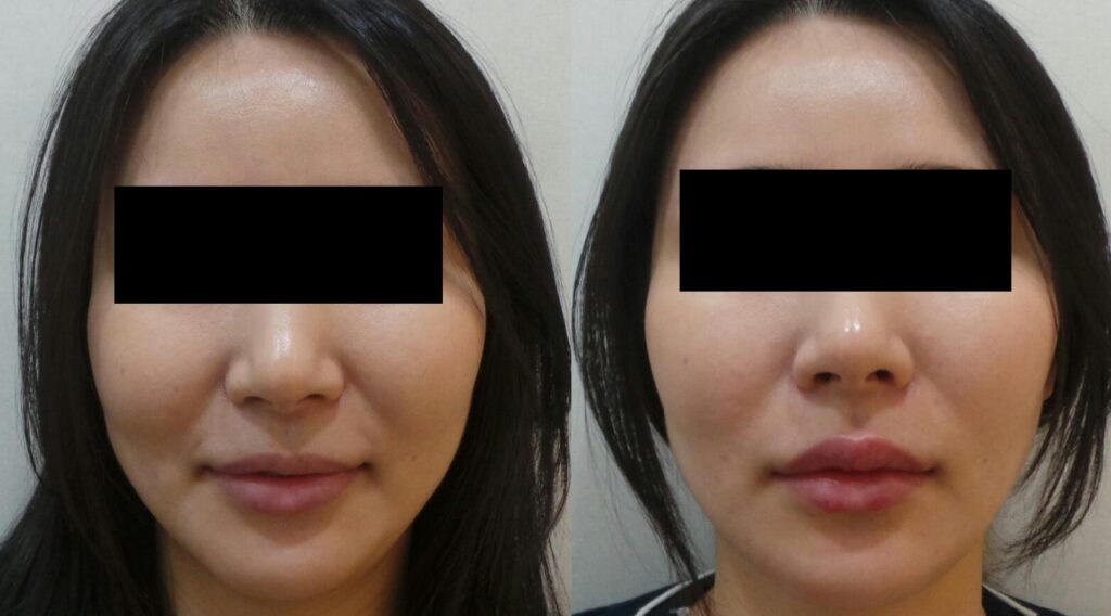 일산 입술필러 전후사진 정면, 얼굴 전체의 모습에 자연스럽게 어울리는 입술