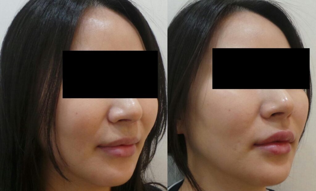 일산 입술필러 전후사진 대각선 각도, 입꼬리 라인과 입술 윤곽 변화를 비교한 이미지