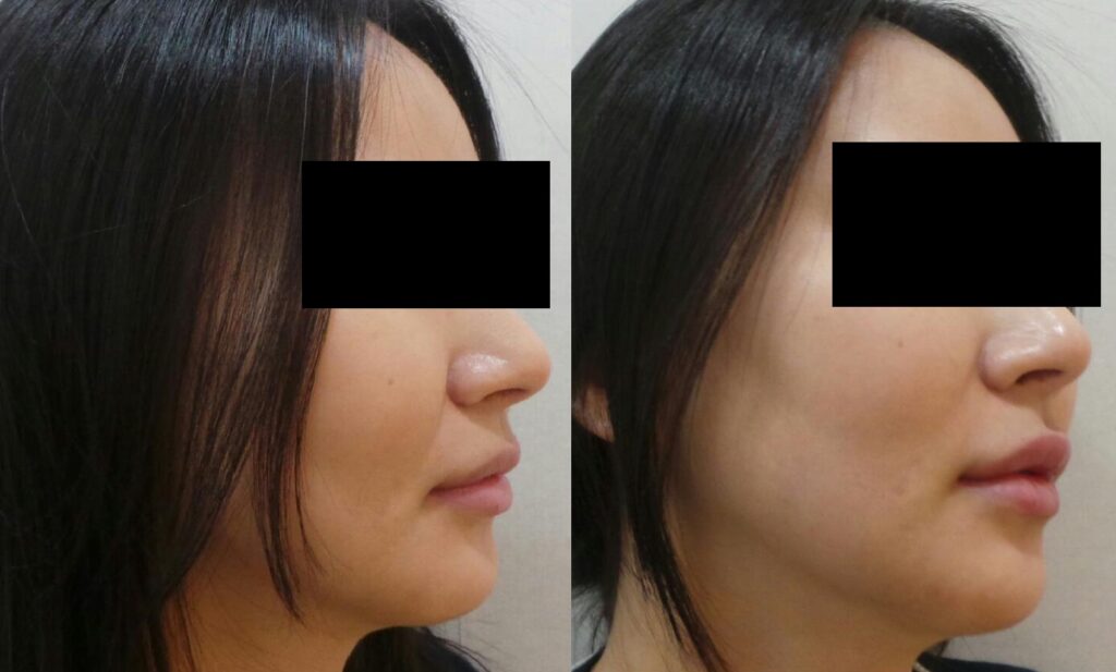파주·김포 인근 입술필러 전후사진 측면, 입술 돌출감과 얼굴 측면 비율 변화를 비교한 모습