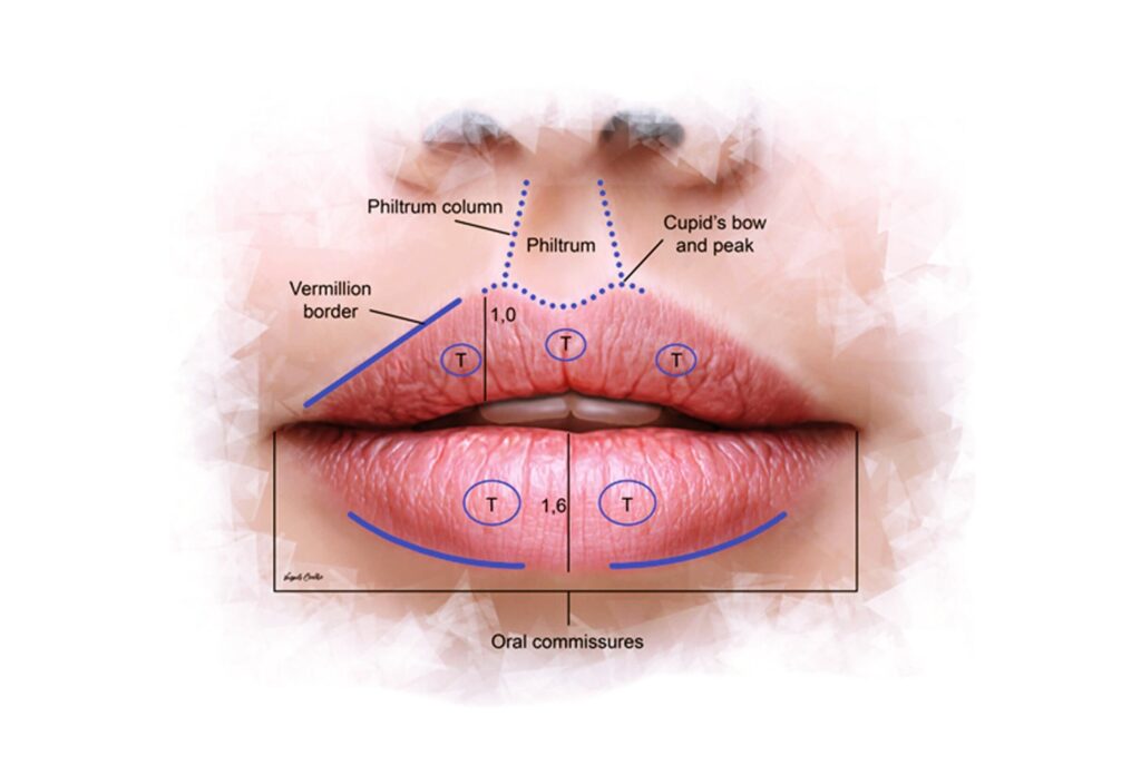 입술 형태와 얼굴 비율에 따라 입술 필러 기준이 달라질 수 있음을 설명한 도식 이미지