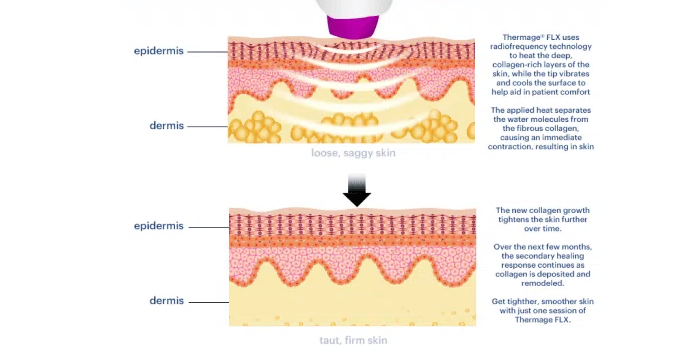 써마지 고주파 자극으로 피부 진피층에서 열 반응이 발생하는 과정을 단계별로 나타낸 그림
