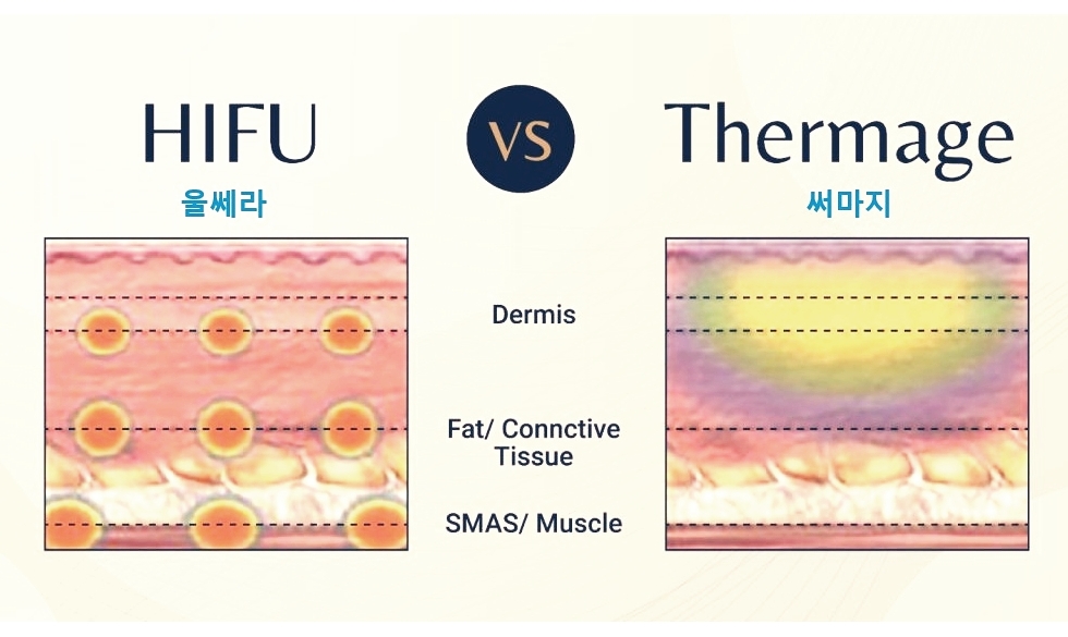 써마지와 초음파 리프팅의 에너지 전달 깊이를 비교한 개념도