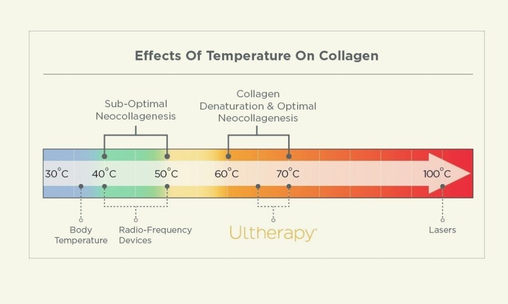온도 변화에 따른 콜라겐 변성(denaturation)과 콜라겐 합성(neocollagenesis)을 나타낸 개념도