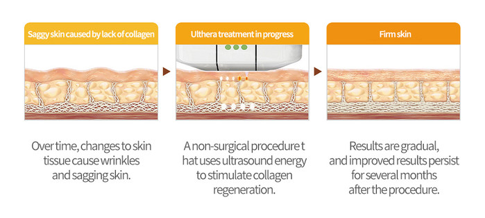울쎄라 트랜스듀서 1.5mm·3.0mm·4.5mm가 작용하여 피부 상태를 개선시키는 그림.