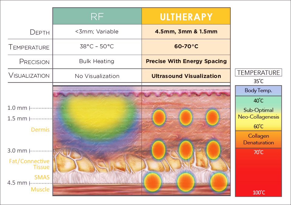 울쎄라와 써마지의 침투 깊이를 나타내는 그림