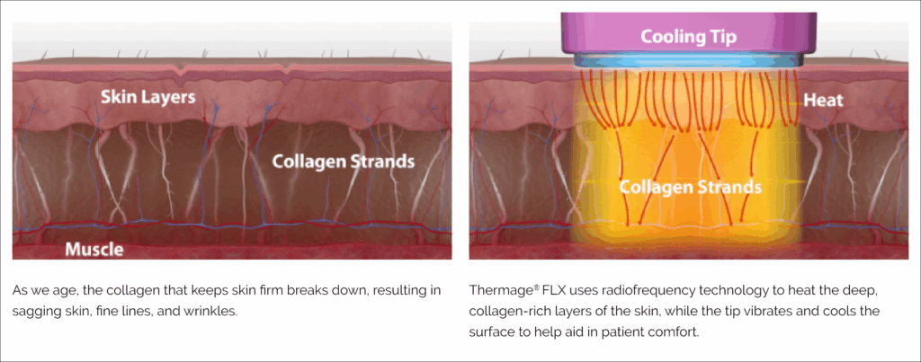 써마지 고주파 에너지가 진피층 전체에 열을 전달해 콜라겐 재생을 유도하는 원리를 설명한 이미지
