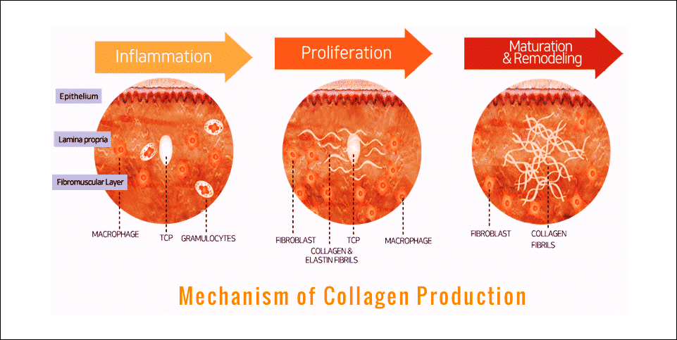 울쎄라 시술 후 콜라겐이 생성되고 재배열되는 과정을 나타낸 도식 그림. 울쎄라 효과 언제부터 나타나는지 보여줌.