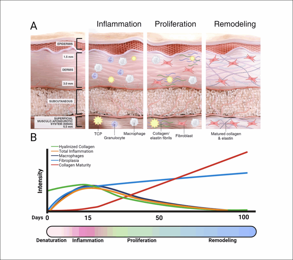 울쎄라 효과 언제부터 나타나는지 시술 후 시기별 효과 및 콜라겐 생성 정도를 보여주는 모식도와 그래프.