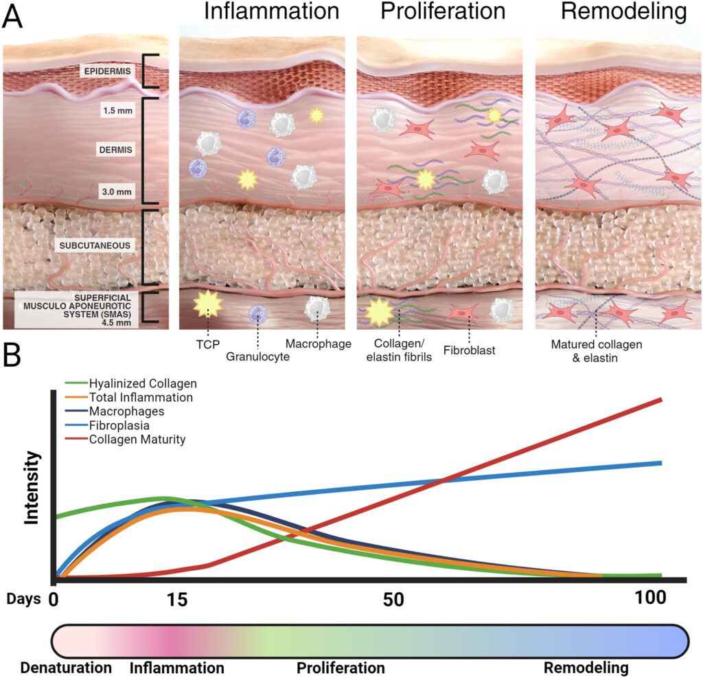 울쎄라 시술 후 시간에 따른 콜라겐 재형성과 리프팅 효과 변화를 보여주는 그래프