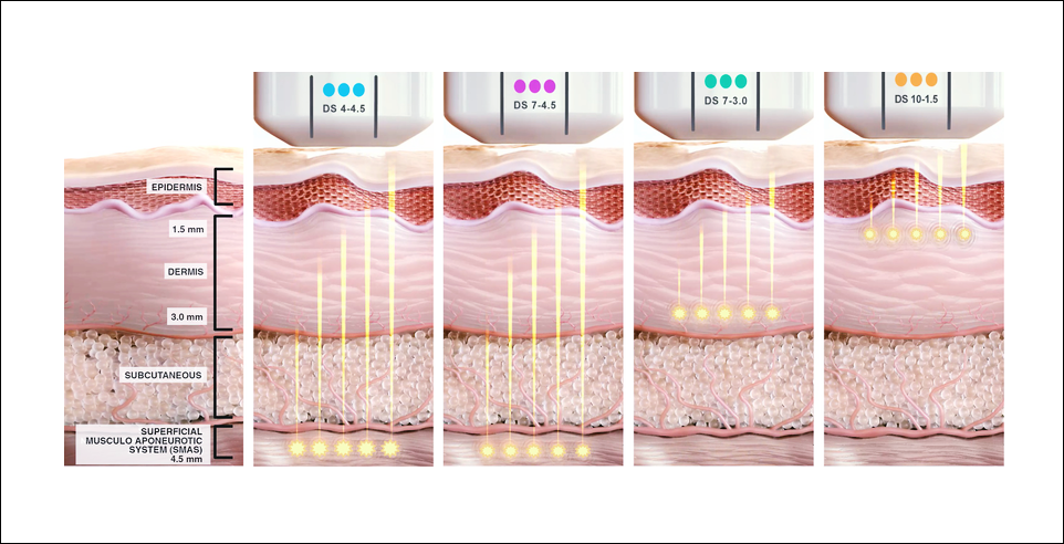 울쎄라 고강도 집속 초음파가 표재성 근막층에 열 자극을 전달하는 모습.