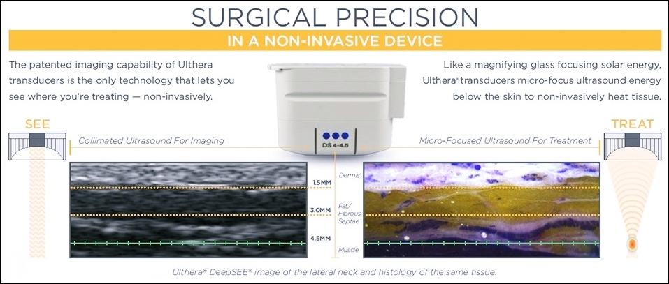 울쎄라 초음파가 SMAS층까지 도달해 열 응고점을 형성하는 원리를 설명한 이미
