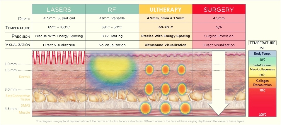 울쎄라 써마지 초음파 및 고주파 시술의 차이를 피부 층별 작용 깊이로 비교한 구조 이미지