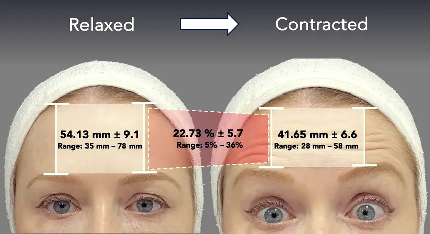 이마 근육(frontalis muscle)이 수축해 눈꺼풀을 올리는 모습