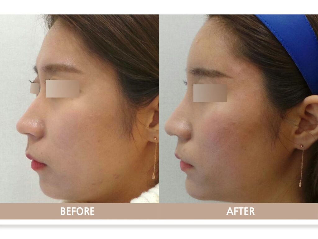 이마만 보지 않고 얼굴 전체의 조화를 고려해 이마와 코, 턱에 필러를 시술한 일산 이마 필러 전후 사진