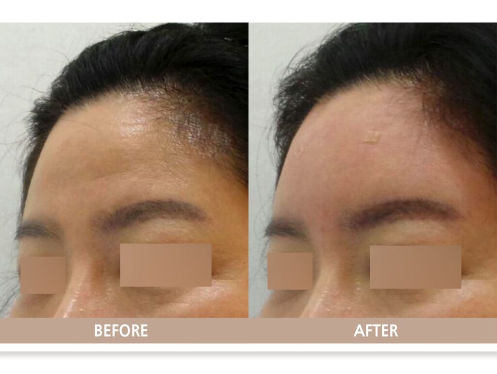 일산 리뉴앤영 의원의 이마 필러 전후 사진으로, 시술 전 평평하고 꺼져 보이던 이마 라인이 시술 후 얼굴 비율에 맞게 보완된 모습