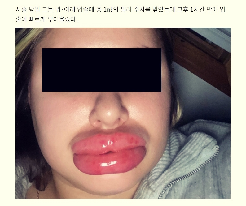 필러 시술 후 알레르기 반응으로 얼굴 붓기와 두드러기가 빠르게 나타난 해외의 필러 부작용 사례.