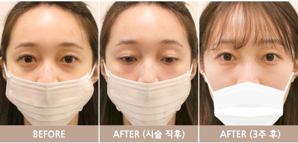 일산 리뉴앤영의원 눈밑필러 시술 전과 직후, 3주 후의 눈물고랑 꺼짐과 다크서클 음영 변화를 비교한 사진