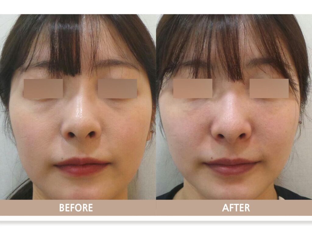 젊은 환자의 눈밑 꺼짐과 다크서클 음영을 비교한 눈밑 필러 정면 전후사진