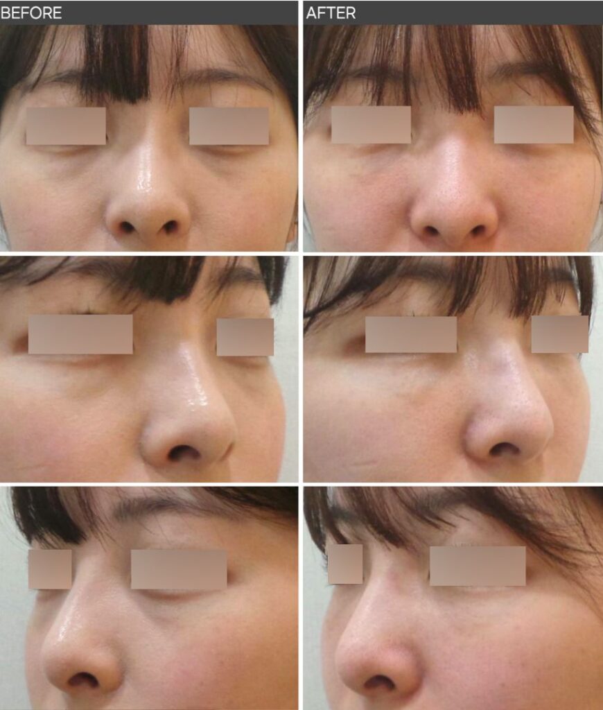 정면과 측면 등 다양한 각도에서 젊은층의 다크서클과 눈밑 고랑 변화를 비교한 눈밑 필러 전후사진