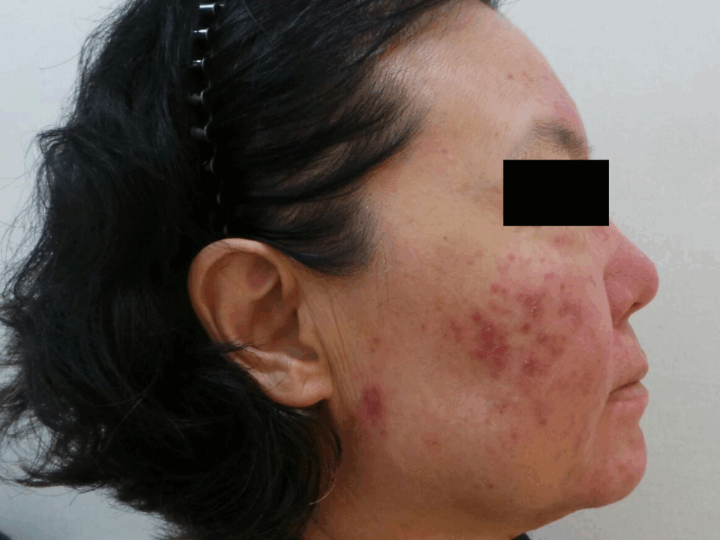 M22 IPL 1회 안면 홍조 치료 후 얼굴의 붉은기와 염증성 구진이 치료 전보다 완화된 피부 상태를 보여주는 정면 사진.