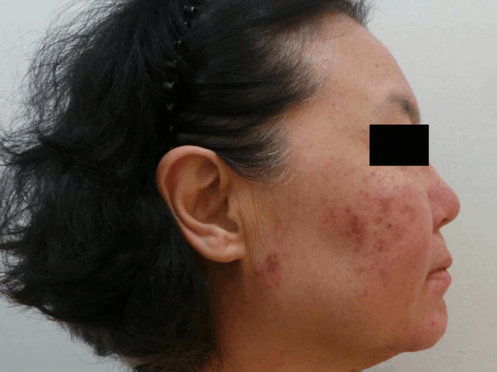M22 IPL과 엑셀브이 플러스를 이용한 얼굴 홍조 2회차 치료 후 붉은기와 염증성 구진이 1회차보다 더 완화된 피부 상태를 보여주는 측면 사진