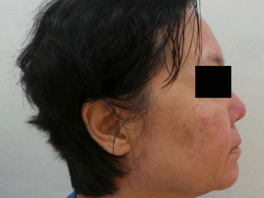 안면 홍조 3회차 치료 후 측면에서 확인한 사진으로, 치료 전보다 붉은기와 염증성 구진이 크게 완화된 피부 상태