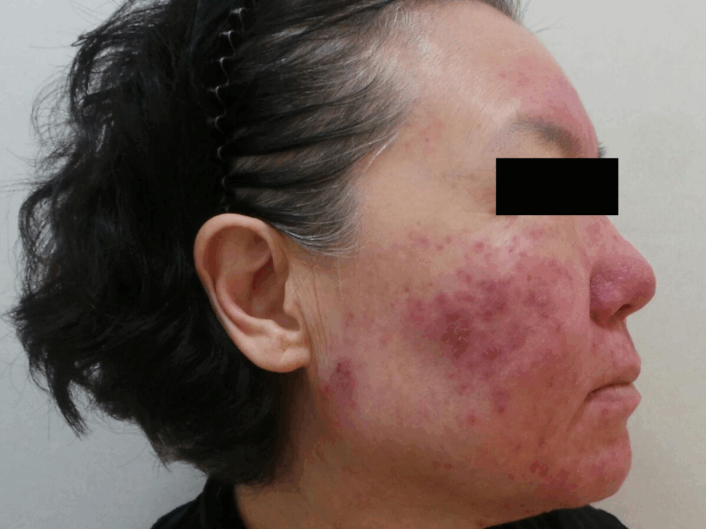 얼굴 홍조 치료 전 볼과 코 주변에 심한 붉은기와 염증성 구진이 넓게 나타난 피부 상태를 보여주는 정면 사진