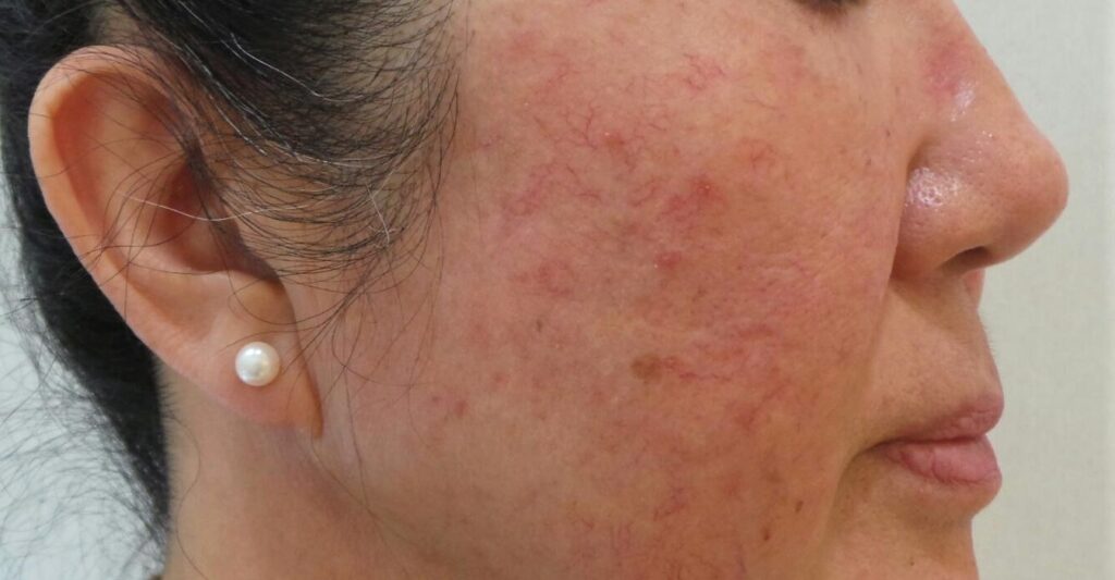 양 볼과 코를 중심으로 지속적인 붉은기와 염증성 구진이 함께 나타난 얼굴 주사피부염 피부 상태를 촬영한 사진