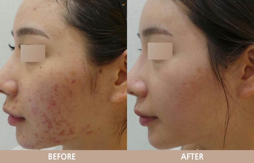 일산 여드름 피부과 글에서 설명하는 여드름 치료 전후 비교 사진으로 염증과 붉은 자국 변화를 보여주는 이미지