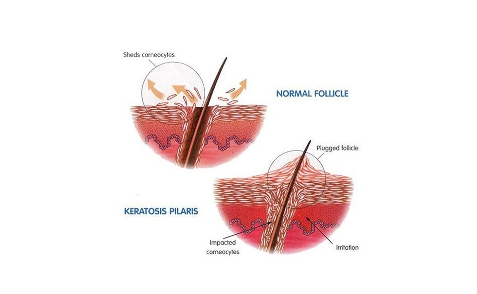모낭 입구에 케라틴 각질이 쌓여 각질 마개가 생기고 모공각화증이 발생하는 과정을 설명한 이미지