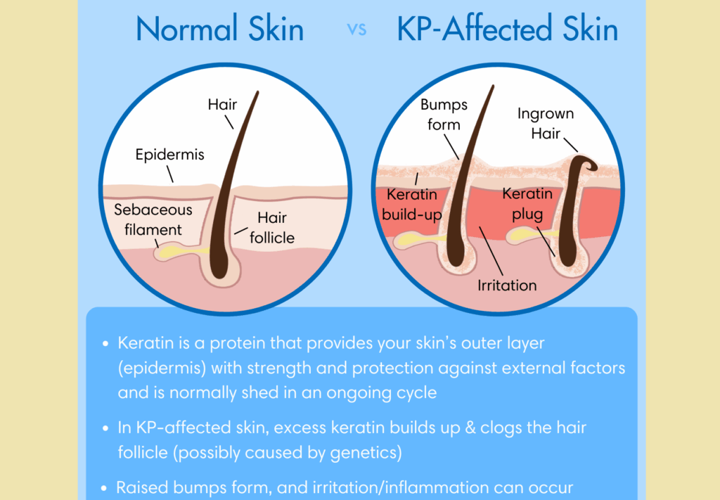 모낭 입구에 케라틴 각질이 쌓여 각질 마개가 형성되고 모공각화증 돌기가 생기는 과정을 설명한 그림