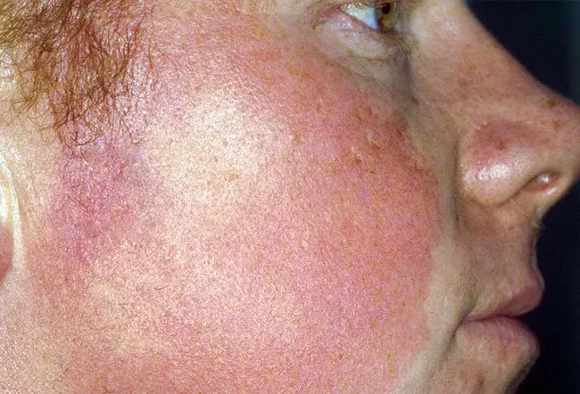 붉은기가 심하게 동반된 Keratosis Pilaris Rubra 병변이 팔 피부에 나타난 사진
