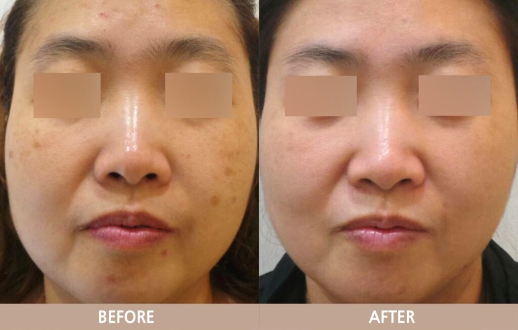 기미와 잡티가 함께 있는 얼굴의 치료 전후 변화를 보여주는 예시 사진