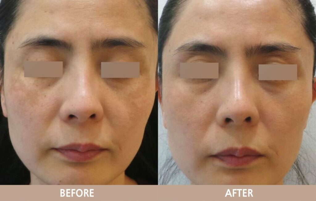 얼굴 기미 병변의 치료 전후 변화를 보여주는 사진