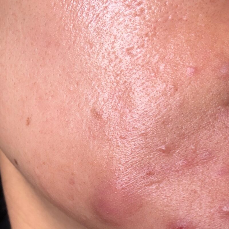 성인 여성의 턱과 턱선 부위에 반복되는 염증성 여드름 병변을 보여주는 이미지