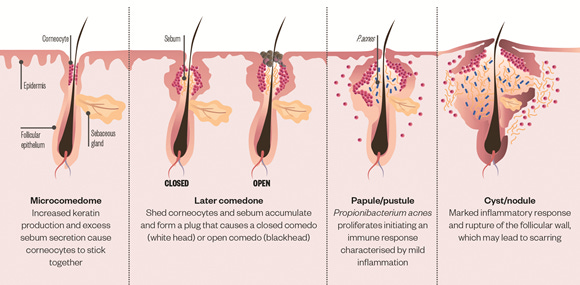 좁쌀여드름이 피지와 각질 축적, C. acnes 증식, 염증 반응을 거쳐 구진과 농포 형태의 염증성 여드름으로 진행되는 과정을 보여주는 이미지